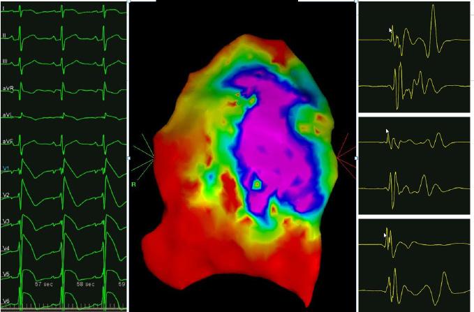 Syndrome ABLATION San Donato Milanese (Milan), Italy - February 16-17-18, 2017 www.af-ablation.