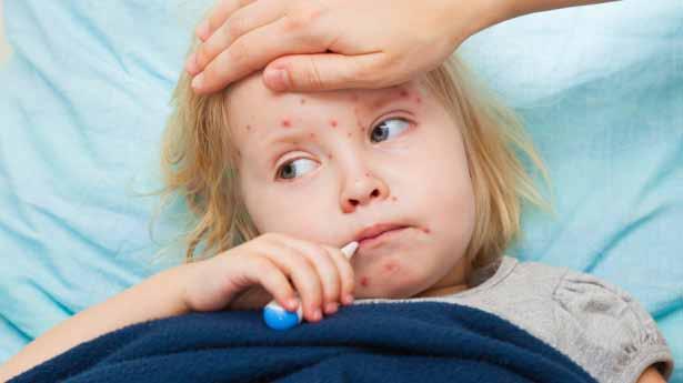 Measles is a highly contagious respiratory disease that causes fever, red and sore eyes, runny nose, cough and a characteristic rash.